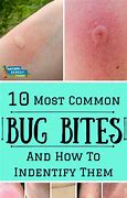Image result for Mosquito Bug Bites