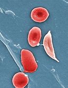 Image result for Sickle Cell Pictures