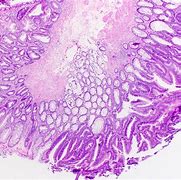 Image result for Sessile Serrated Adenoma Polyp Colon