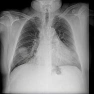 Image result for Solitary Nodule of Lung 6Cm