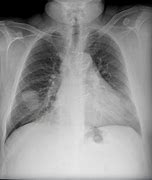 Image result for Lung Nodules On CT Scan