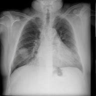 Image result for Pulmonary Nodules in Lungs