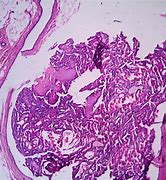 Image result for Papilloma Scalp