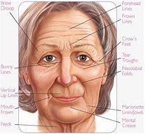 Image result for Types of Facial Wrinkles
