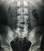 Image result for Spina Bifida Occulta S1