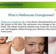Image result for Molluscum Contagiosum Treatment Freezing