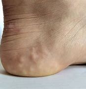 Image result for Bumps On Bottom of Feet
