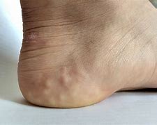 Image result for White Spots On Foot