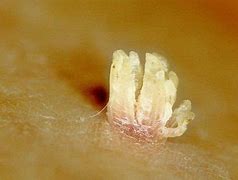 Image result for Verruca Vulgaris Mouth