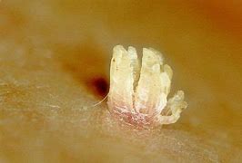 Image result for Throat Warts