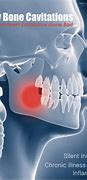 Image result for Infection in Jaw Bone