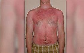 Image result for SunBurn On Dark Skin