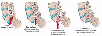 Image result for Minimal Grade 1 Anterolisthesis of C4 On C5