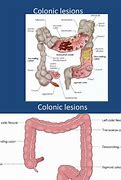 Image result for Annular Lesion Colon