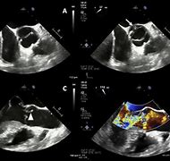 Image result for Bicuspid Aortic Valve Tee