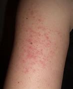 Image result for Keratosis pilaris