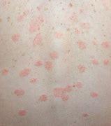 Image result for Rosaria Skin Disease