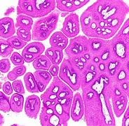 Image result for Papilloma Images
