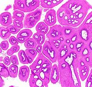 Image result for Squamous Cell Papilloma of Skin Pathology
