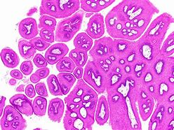 Image result for Subungual Papilloma