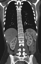 Image result for CT Scan Spine