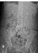 Image result for Uresil Nephrostomy Catheter
