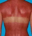 Image result for Blood Dots On Skin From Sun Burn