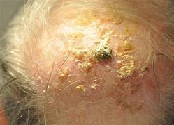 Image result for Blue Light Treatment Actinic Keratosis