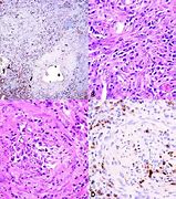 Image result for 10 mm Lung Nodule