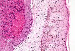 Image result for Molluscum Contagiosum Cure