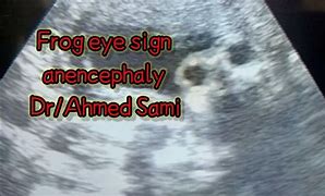 Image result for Frog Sign Anencephaly