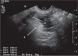 Image result for Transvaginal Ultrasound Ovarian Cyst