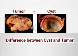 Image result for Cyst Is Cancer