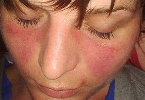 Image result for Lupus Skin Rashes in Adults