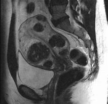 Image result for Fibroid Uterus MRI