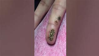 Image result for Cauterize Warts
