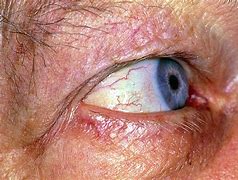 Image result for Irritant Eyes with Bowel Cancer