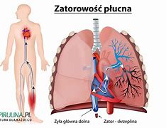 Image result for co_to_za_zatorowość_płucna