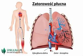 Image result for co_to_znaczy_zator_płuc