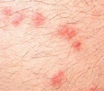 Image result for Mouse Bite