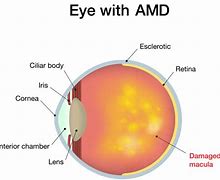 Image result for Eye with Alzeimer's and AMD