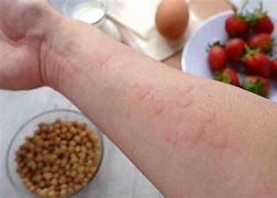 Image result for Food Allergy Symptoms Skin Rash