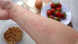 Image result for Food Allergy Rash Toddler
