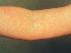 Image result for Slap Cheek Fifth Disease
