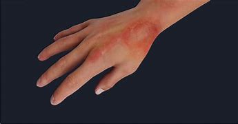 Image result for Burn Injuries