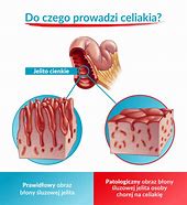 Image result for celiakia