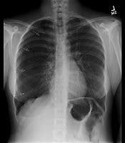 Image result for Spontaneous Pneumothorax