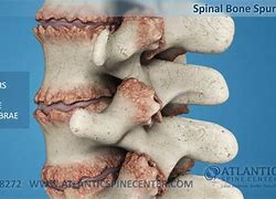 Image result for Bone Spurs Spine