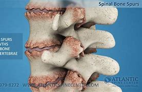 Image result for Bone Spurs Spine Numbers Vertebrae