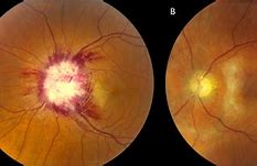 Image result for Ocular Syphilis